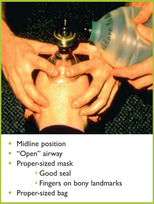 Figure 2. Bag-valve-mask ventilation