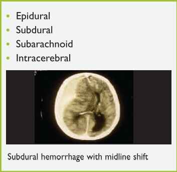 Figure 7. Types of Intracranial Hemorrhage