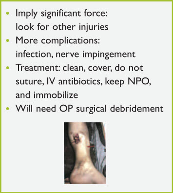 Figure 10. Open fractures