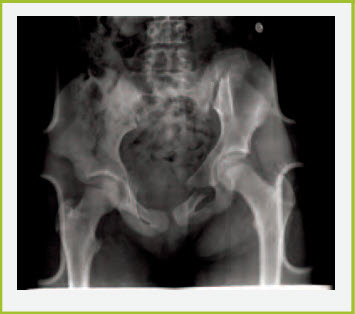 Figure 11. Hip fracture